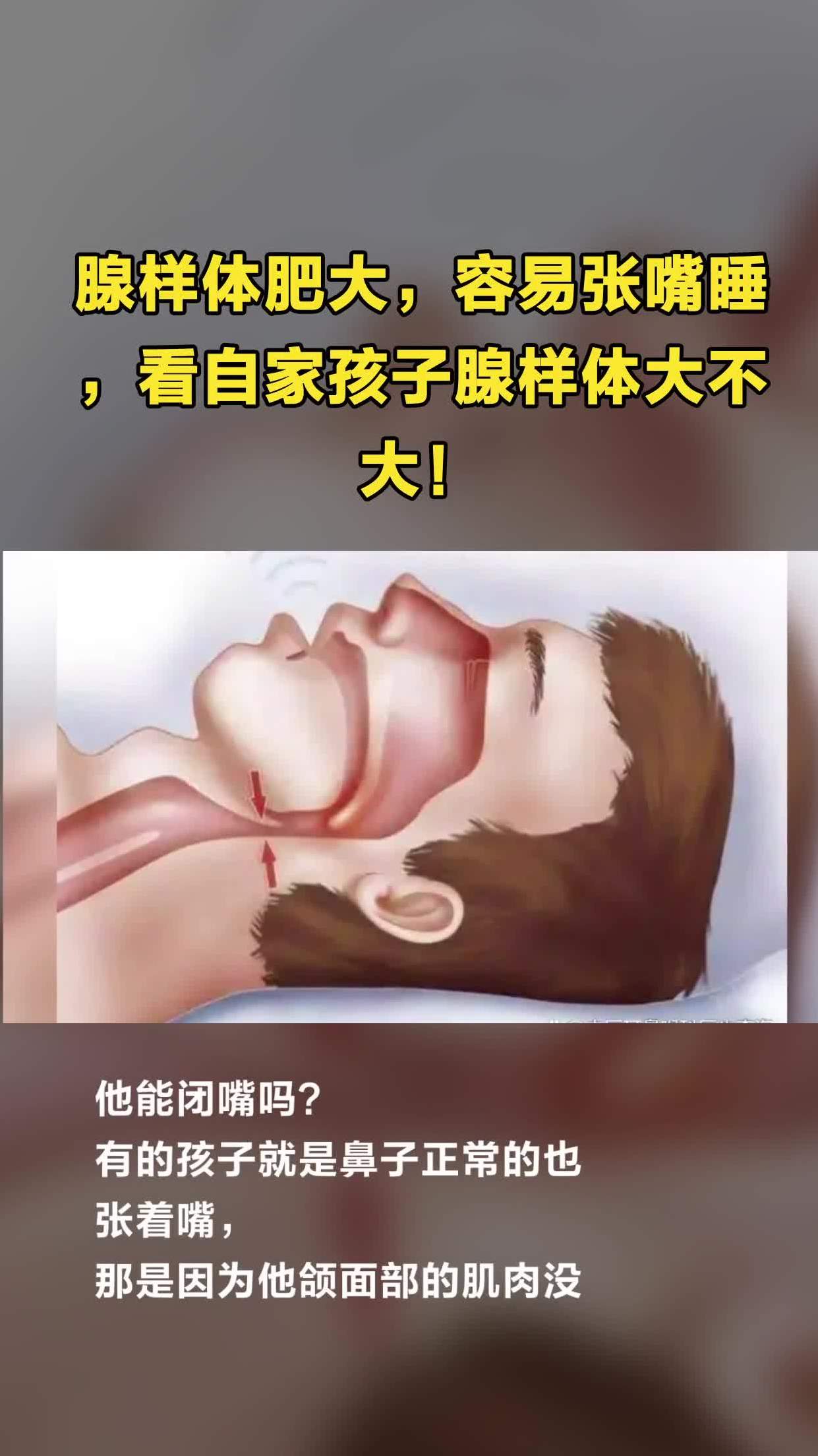 腺样体肥大,容易张嘴睡,看自家孩子腺样体大不大!